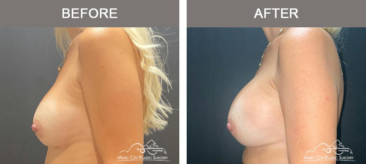 Implant Exchange Before & After Gallery - Patient 518854 - Image 4