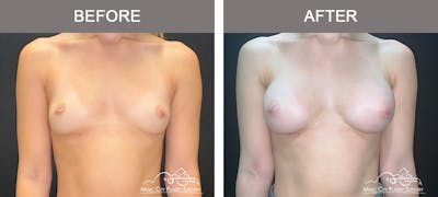 Breast Augmentation Before & After Gallery - Patient 475558 - Image 1