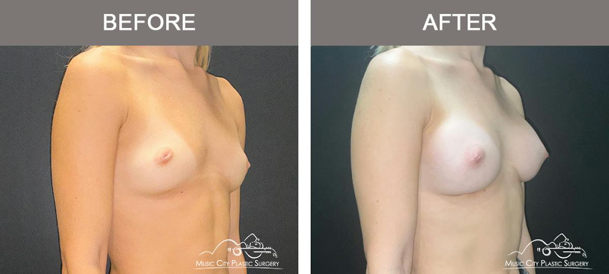 Breast Augmentation Before & After Gallery - Patient 475558 - Image 2
