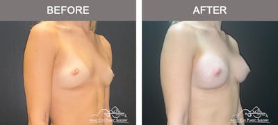 Breast Augmentation Before & After Gallery - Patient 475558 - Image 2