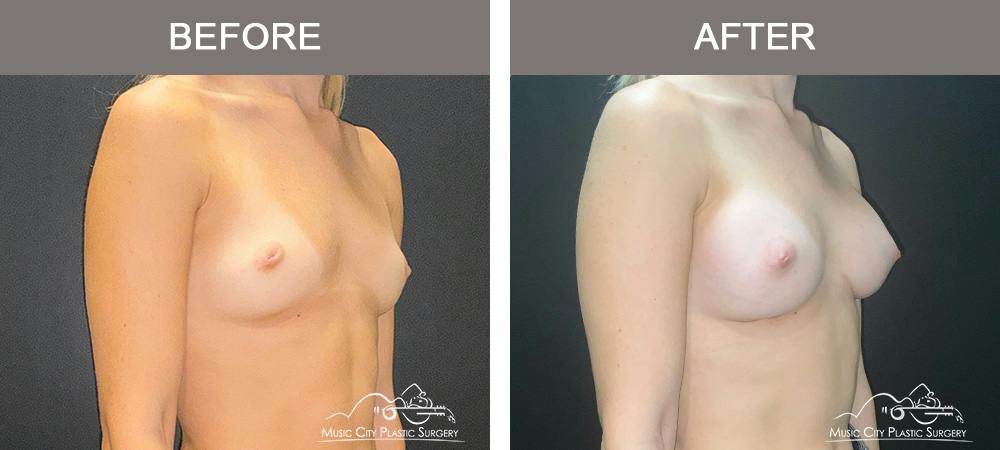 Breast Augmentation Before & After Gallery - Patient 475558 - Image 2