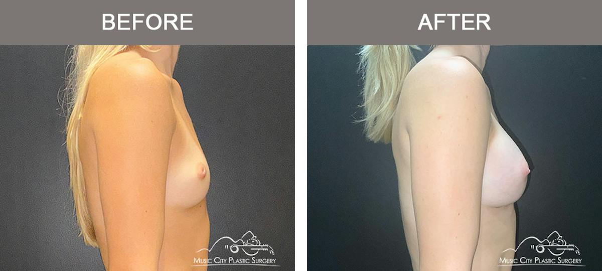 Breast Augmentation Before & After Gallery - Patient 475558 - Image 3