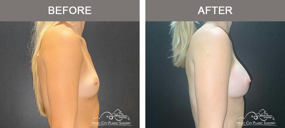 Breast Augmentation Before & After Gallery - Patient 475558 - Image 3