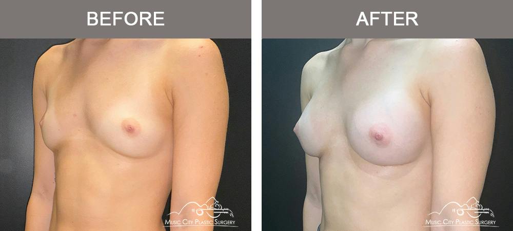 Breast Augmentation Before & After Gallery - Patient 475558 - Image 4