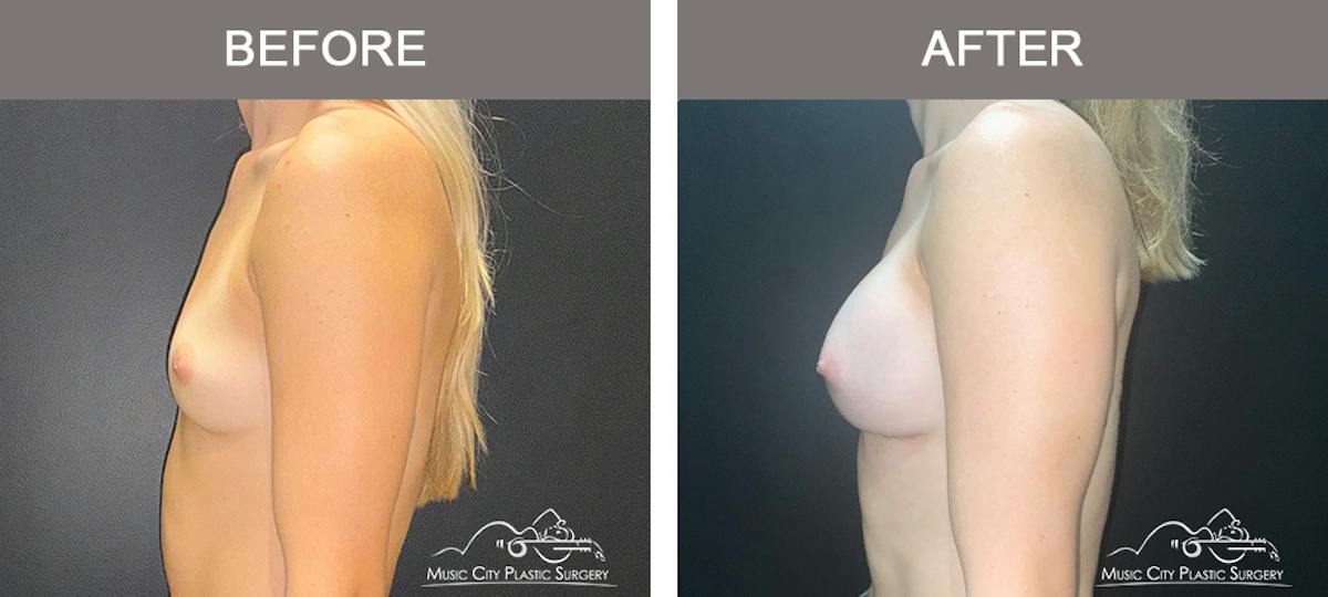 Breast Augmentation Before & After Gallery - Patient 475558 - Image 5