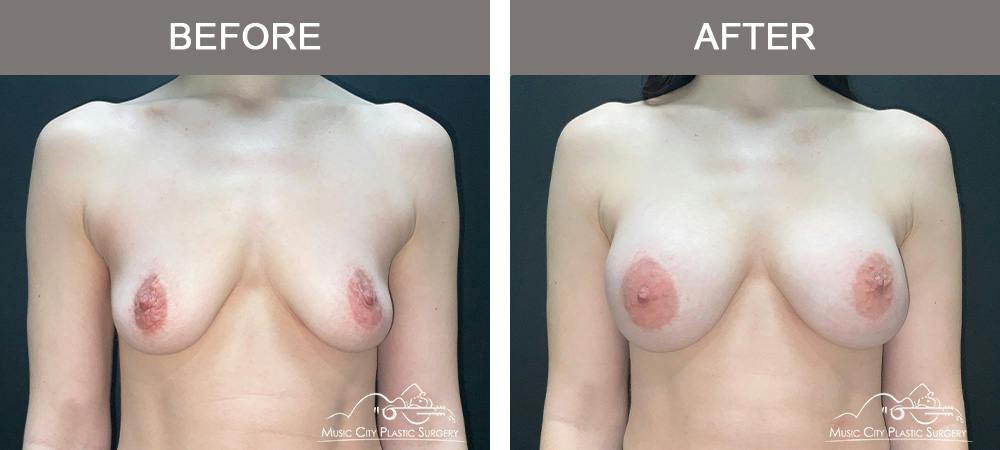 Breast Augmentation Before & After Gallery - Patient 220264 - Image 1