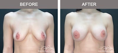Breast Augmentation Before & After Gallery - Patient 220264 - Image 1