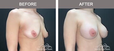 Breast Augmentation Before & After Gallery - Patient 220264 - Image 2