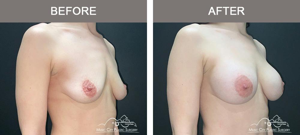 Breast Augmentation Before & After Gallery - Patient 220264 - Image 2