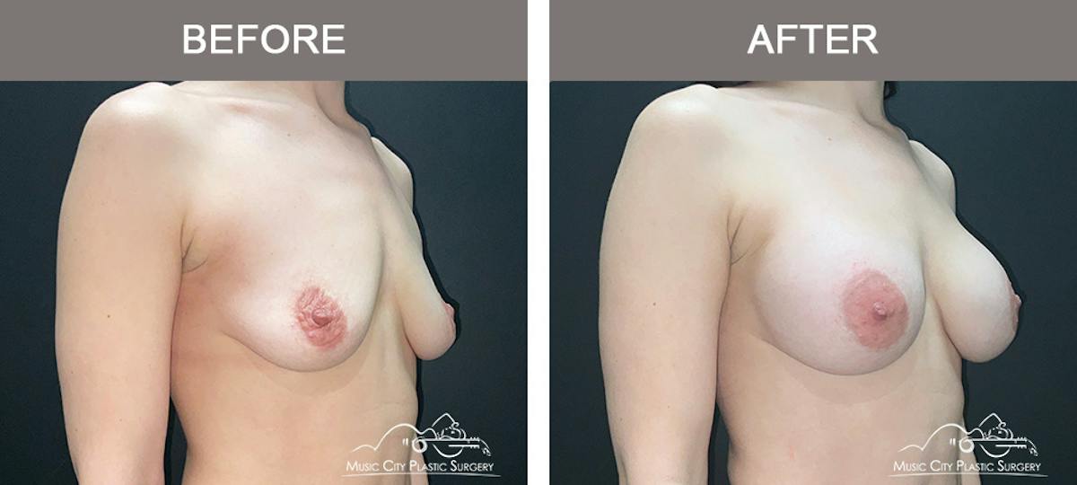 Breast Augmentation Before & After Gallery - Patient 220264 - Image 2