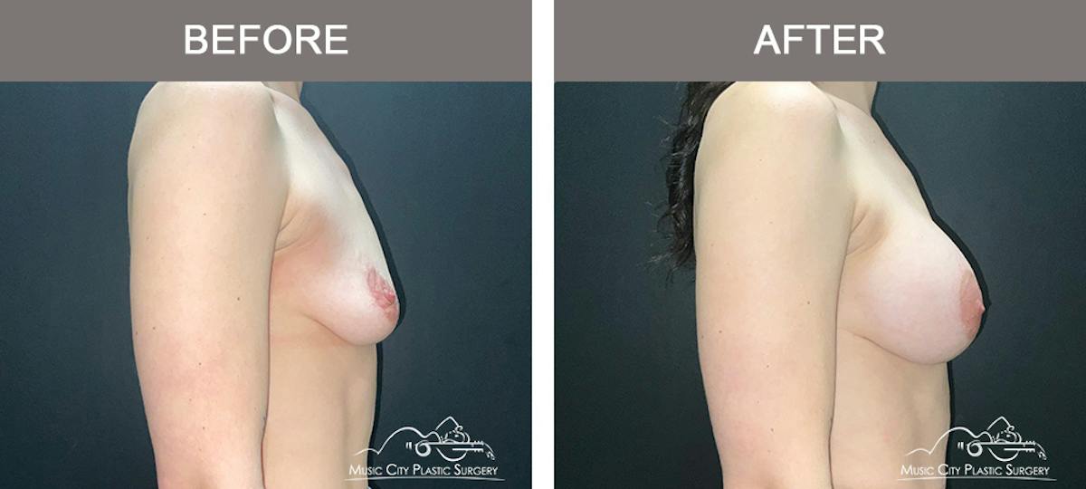 Breast Augmentation Before & After Gallery - Patient 220264 - Image 3