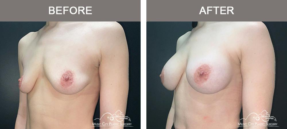 Breast Augmentation Before & After Gallery - Patient 220264 - Image 4