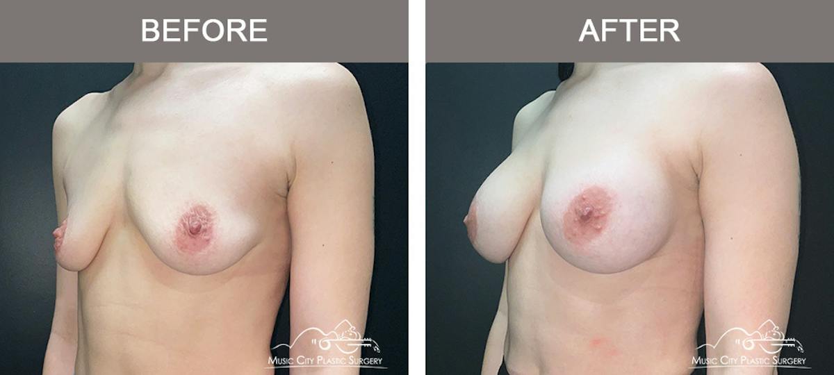 Breast Augmentation Before & After Gallery - Patient 220264 - Image 4
