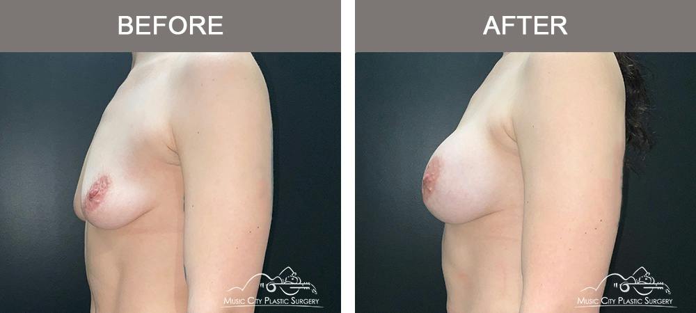 Breast Augmentation Before & After Gallery - Patient 220264 - Image 5