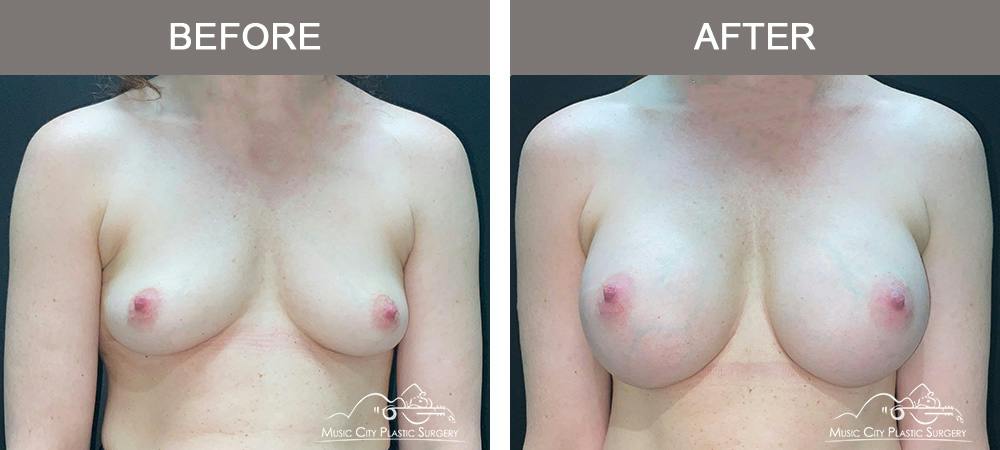 Breast Augmentation Before & After Gallery - Patient 911805 - Image 1