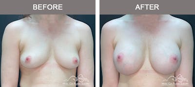 Breast Augmentation Before & After Gallery - Patient 911805 - Image 1
