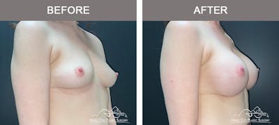 Breast Augmentation Before & After Gallery - Patient 911805 - Image 2