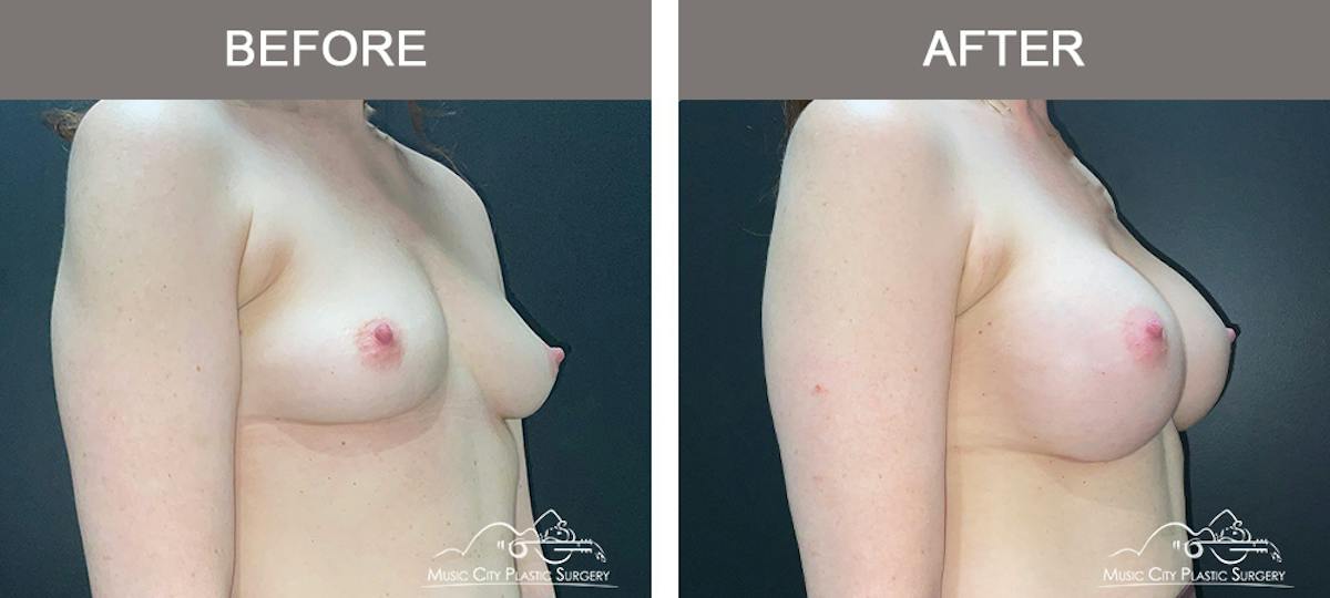 Breast Augmentation Before & After Gallery - Patient 911805 - Image 2