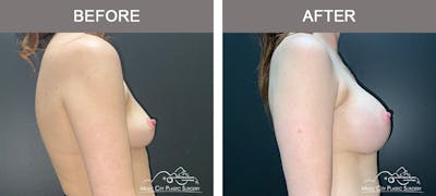 Breast Augmentation Before & After Gallery - Patient 911805 - Image 3