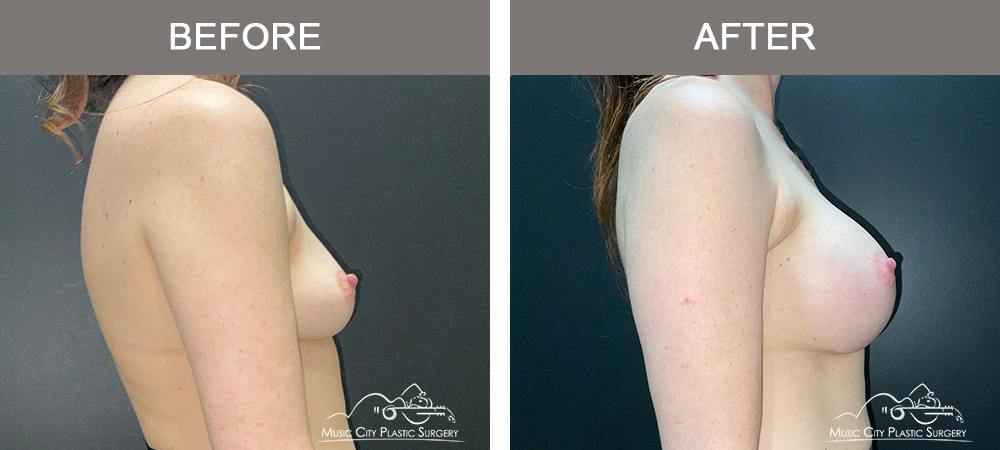 Breast Augmentation Before & After Gallery - Patient 911805 - Image 3