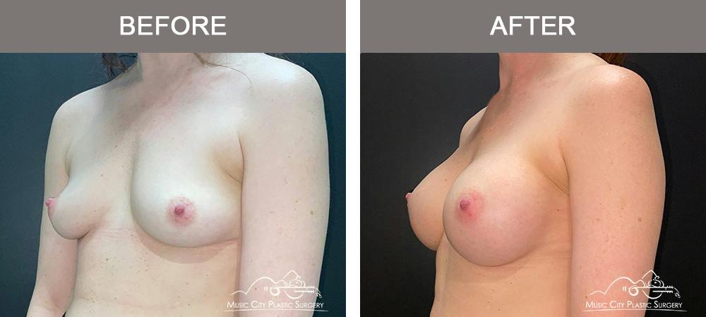 Breast Augmentation Before & After Gallery - Patient 911805 - Image 4
