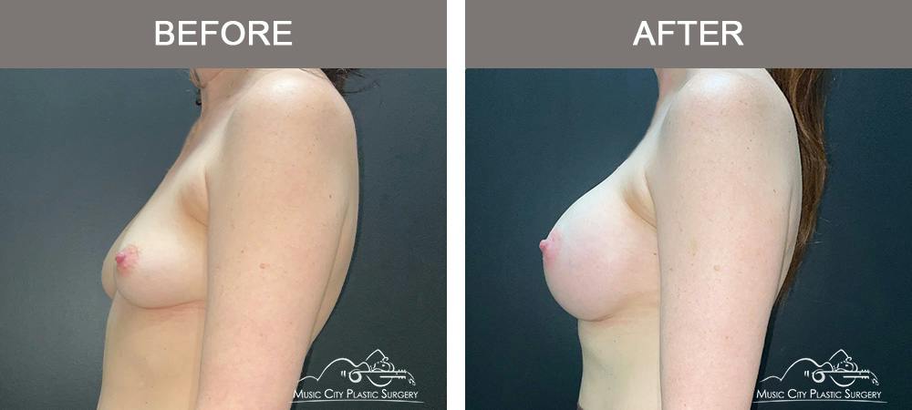 Breast Augmentation Before & After Gallery - Patient 911805 - Image 5