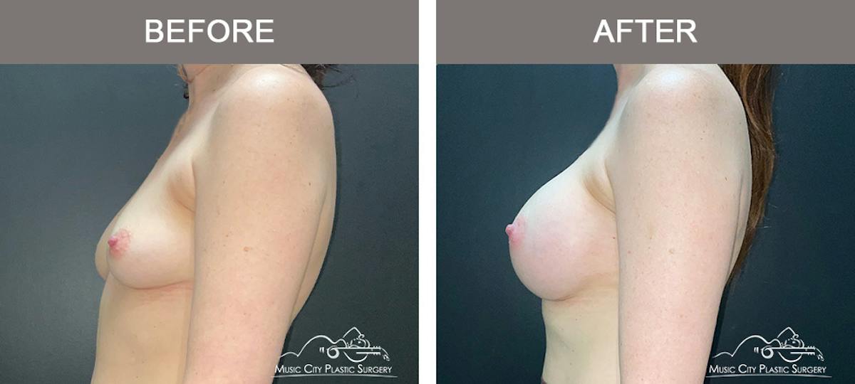 Breast Augmentation Before & After Gallery - Patient 911805 - Image 5