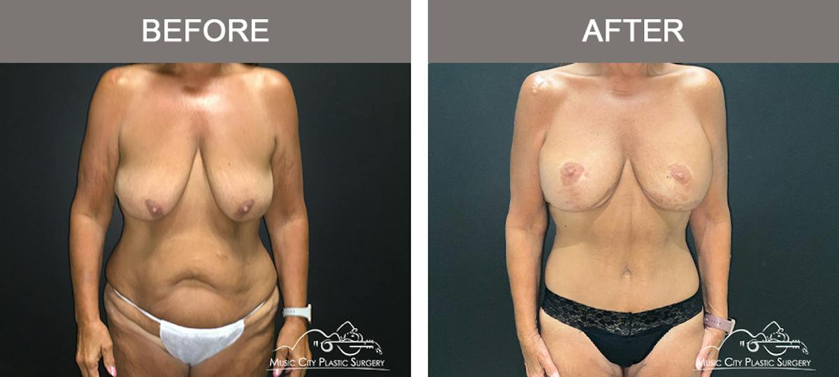 Body Lift Before & After Gallery - Patient 249914 - Image 1