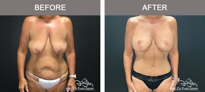 Body Lift Before & After Gallery - Patient 249914 - Image 1