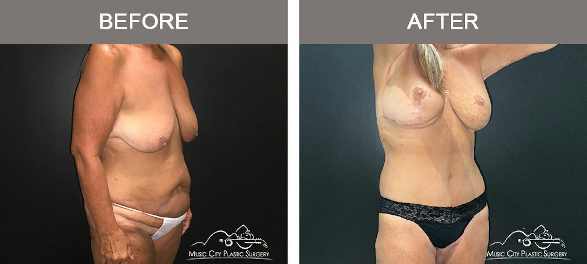 Body Lift Before & After Gallery - Patient 249914 - Image 2