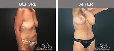 Body Lift Before & After Gallery - Patient 249914 - Image 2