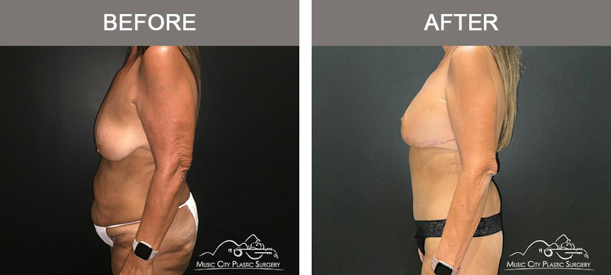Body Lift Before & After Gallery - Patient 249914 - Image 3