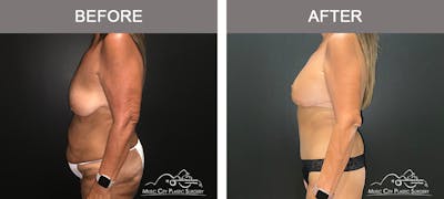 Body Lift Before & After Gallery - Patient 249914 - Image 3