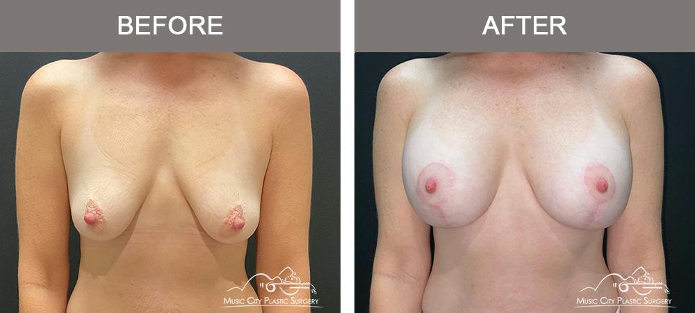 Breast Augmentation Before & After Gallery - Patient 239916 - Image 1