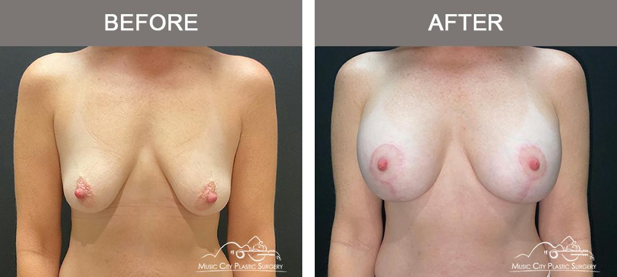 Breast Augmentation Before & After Gallery - Patient 239916 - Image 1