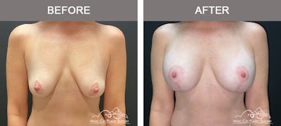 Breast Augmentation Before & After Gallery - Patient 239916 - Image 1