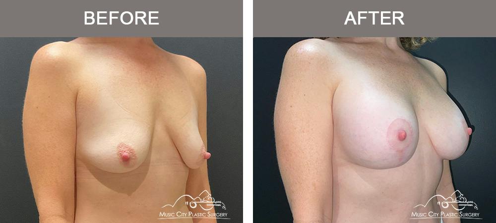 Breast Augmentation Before & After Gallery - Patient 239916 - Image 2