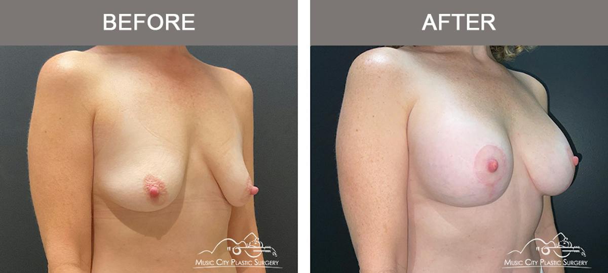 Breast Augmentation Before & After Gallery - Patient 239916 - Image 2