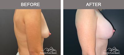 Breast Augmentation Before & After Gallery - Patient 239916 - Image 3
