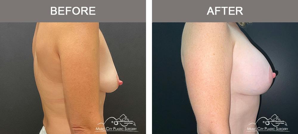 Breast Augmentation Before & After Gallery - Patient 239916 - Image 3