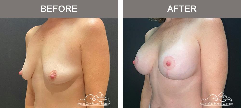 Breast Augmentation Before & After Gallery - Patient 239916 - Image 4