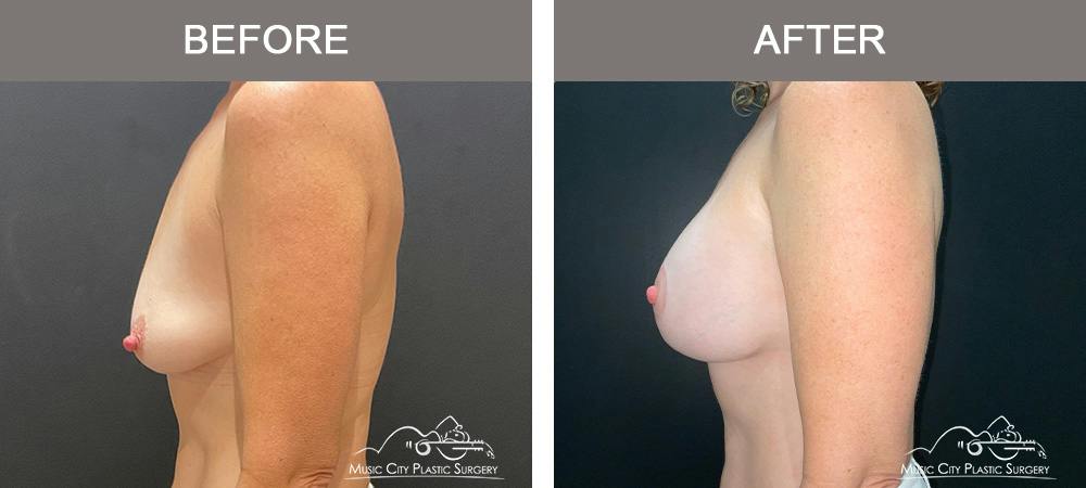 Breast Augmentation Before & After Gallery - Patient 239916 - Image 5