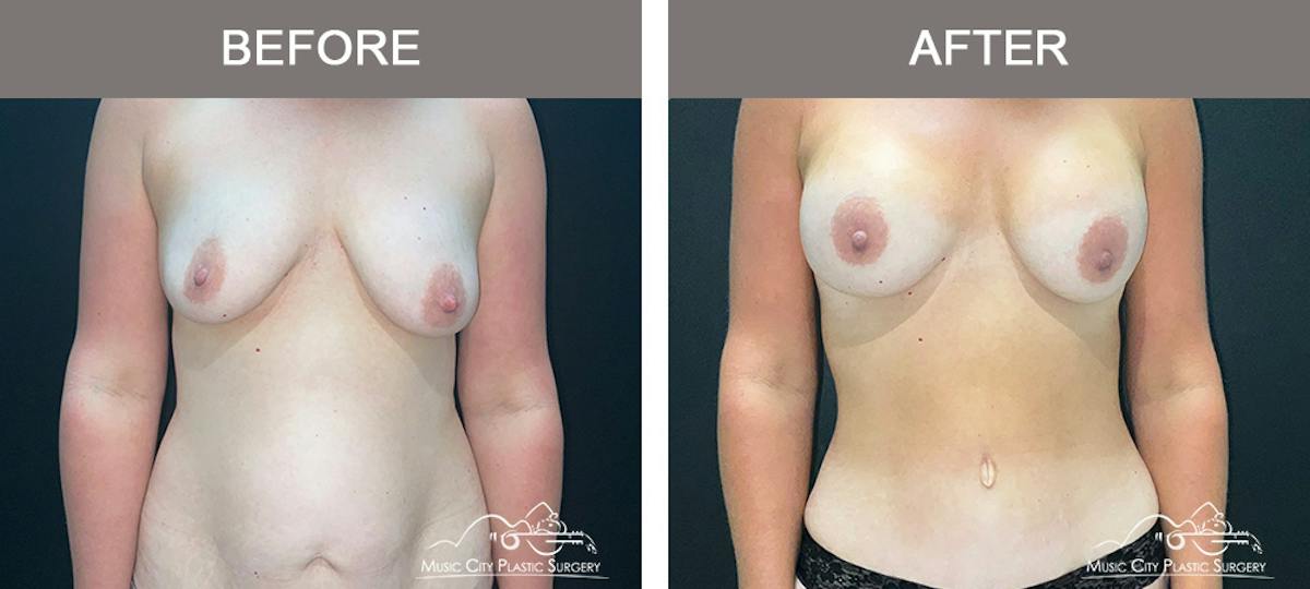Tummy Tuck (Abdominoplasty) Before & After Gallery - Patient 915712 - Image 1
