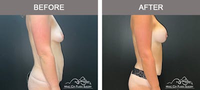 Tummy Tuck (Abdominoplasty) Before & After Gallery - Patient 915712 - Image 3