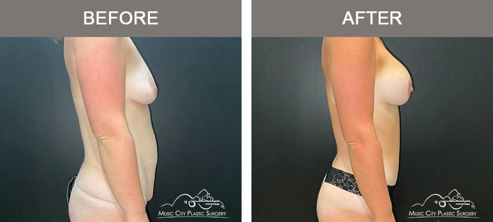 Tummy Tuck (Abdominoplasty) Before & After Gallery - Patient 915712 - Image 3