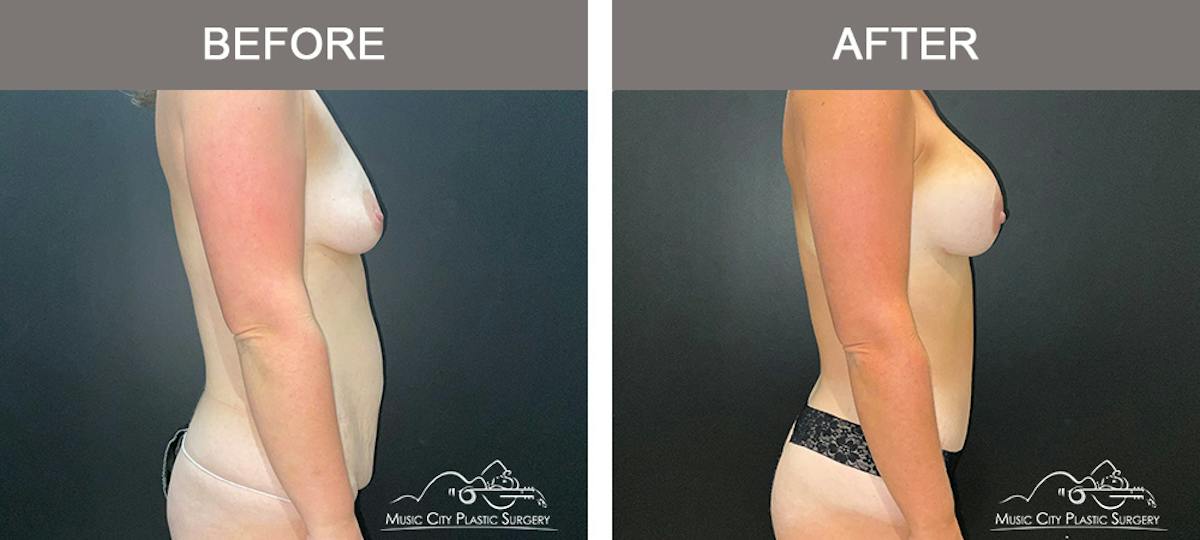 Tummy Tuck (Abdominoplasty) Before & After Gallery - Patient 915712 - Image 3