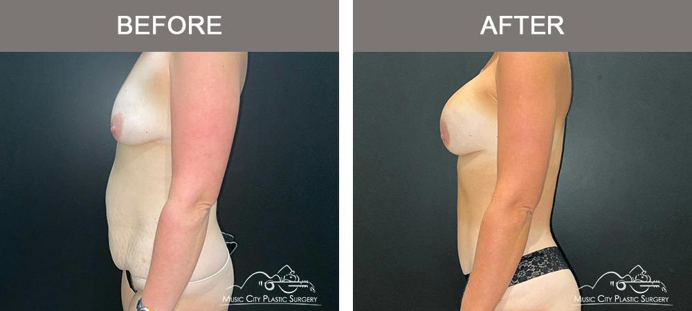 Tummy Tuck (Abdominoplasty) Before & After Gallery - Patient 915712 - Image 6