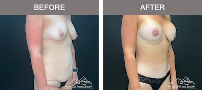 Tummy Tuck (Abdominoplasty) Before & After Gallery - Patient 915712 - Image 2