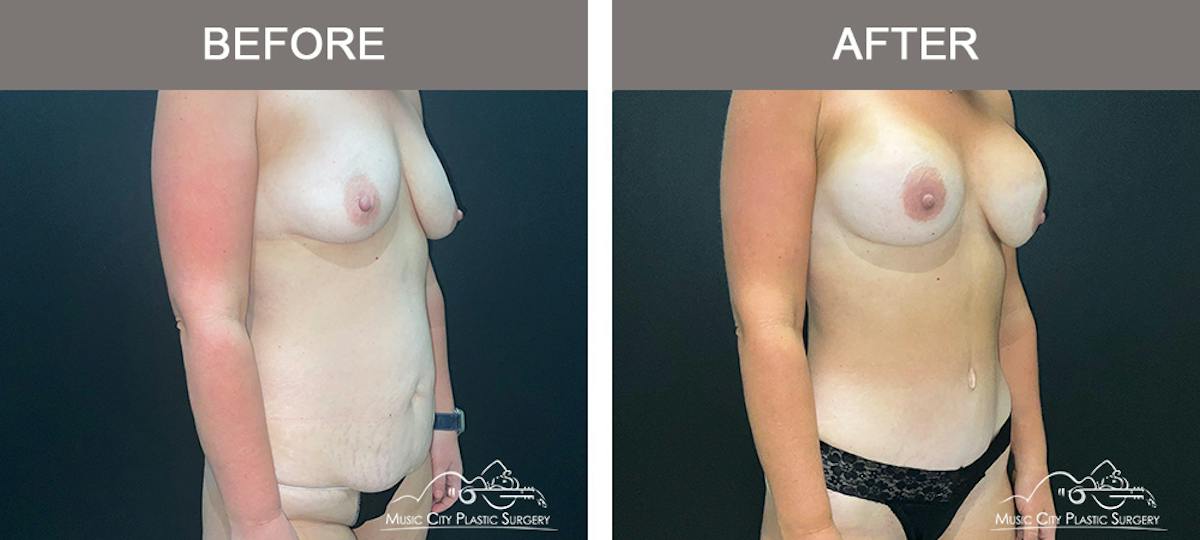 Tummy Tuck (Abdominoplasty) Before & After Gallery - Patient 915712 - Image 2