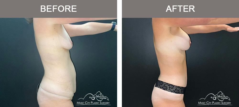 Tummy Tuck (Abdominoplasty) Before & After Gallery - Patient 915712 - Image 4